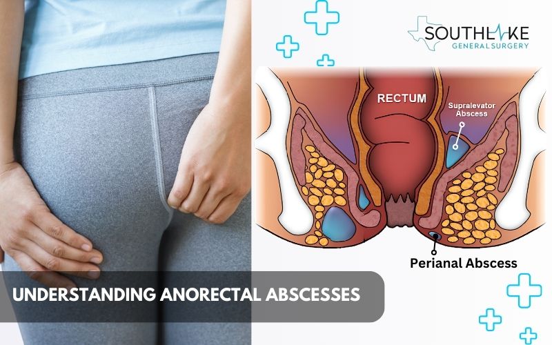 Illustration of anorectal abscess location in the body.