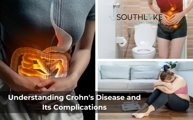 Illustration of common symptoms of Crohn's disease and Fistula: abdominal pain, diarrhea, fatigue, and weight loss.