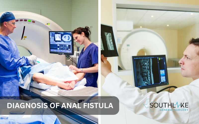 MRI scan image showing the location and severity of an anal fistula.