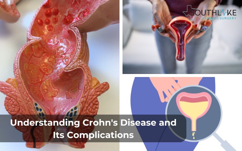 Crohn's Disease and Fistula: Medical illustration depicting different types of fistulas in Crohn's disease, including anal, vaginal, and bladder fistulas.