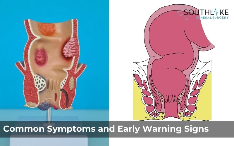 Comparison image of a healthy anal area versus an area affected by an anal fistula.