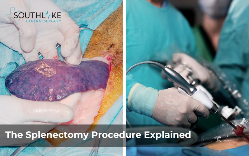 Comparison of open surgery and laparoscopic splenectomy procedures with detailed diagrams of incision points.