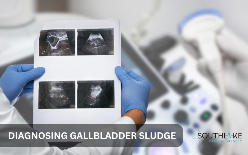 Ultrasound image revealing sludge accumulation in the gallbladder.