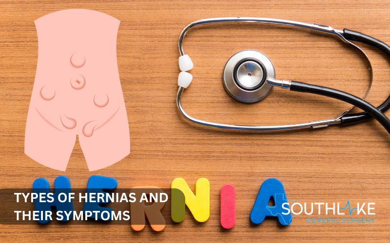 Image of different hernia types: inguinal, femoral, umbilical, and incisional hernias, showing their typical locations in the body.