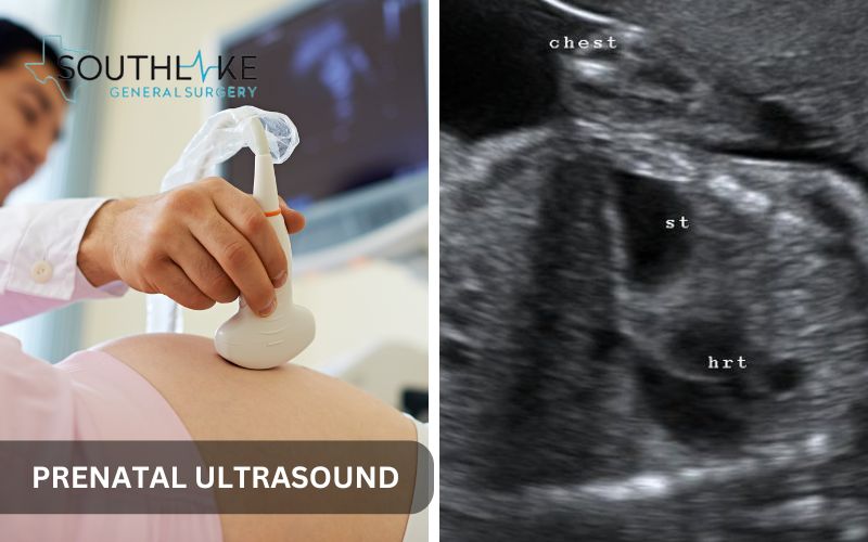 Prenatal ultrasound image detecting CD hernia, with highlighted areas of concern in the developing fetus.