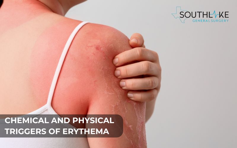 Sunburn-induced erythema: Red and inflamed skin from UV exposure.