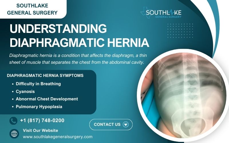 Image showing the diaphragm and how abdominal organs such as the liver, stomach, and intestines can move into the chest cavity in cases of diaphragmatic hernia.