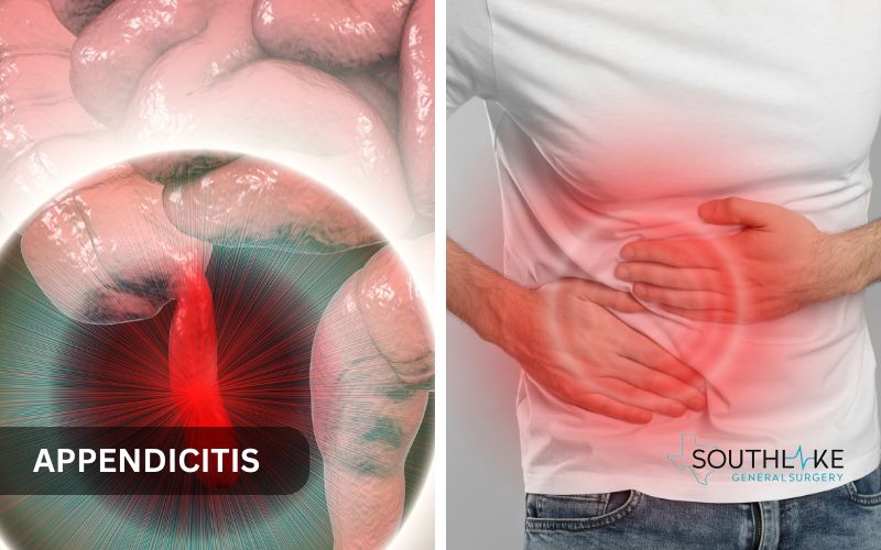 Illustration of an inflamed appendix inside the abdomen.