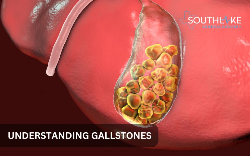 Close-up image of gallstones showing crystallized cholesterol stones inside the gallbladder.