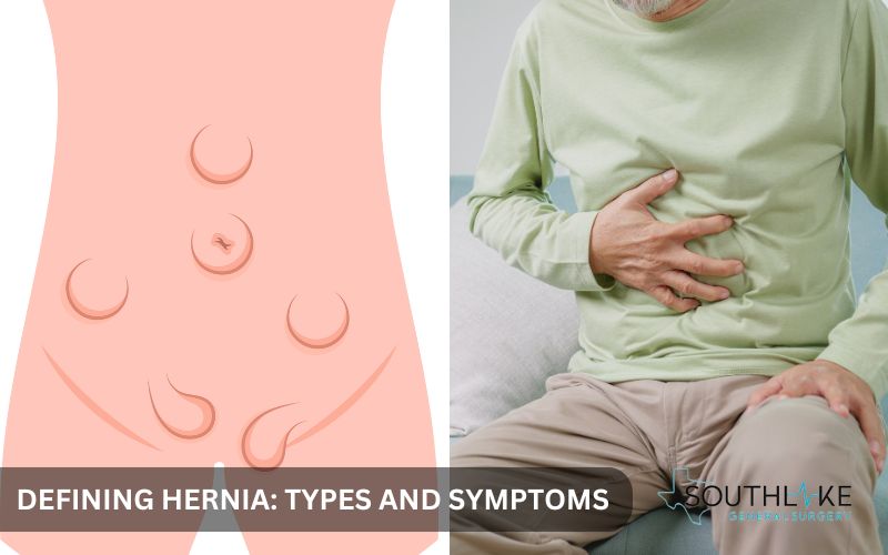 Types of hernias: Inguinal, umbilical, hiatal, and femoral, illustrated with their anatomical locations.