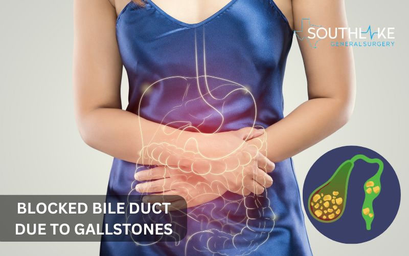 An illustration showing a blocked bile duct due to gallstones, affecting the bile flow to the small intestine.