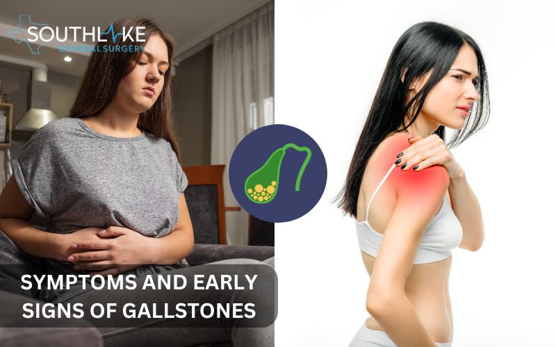 A diagram highlighting the upper-right abdominal pain associated with gallstones and its possible extension to the shoulder.