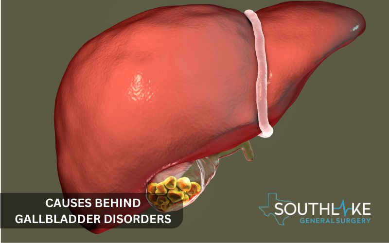 Illustration of cholesterol and pigment gallstones forming in the gallbladder.