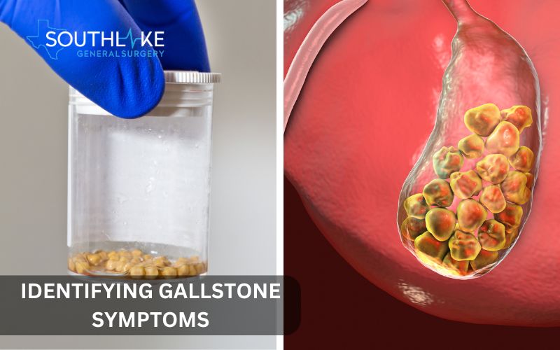 Images of gallstone in gallbladder and in a lab tube.