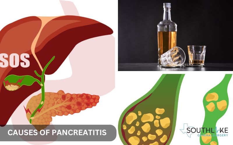 Diagram showing how gallstones and alcohol consumption lead to pancreatitis, indicating the process of pancreatic duct blockage.