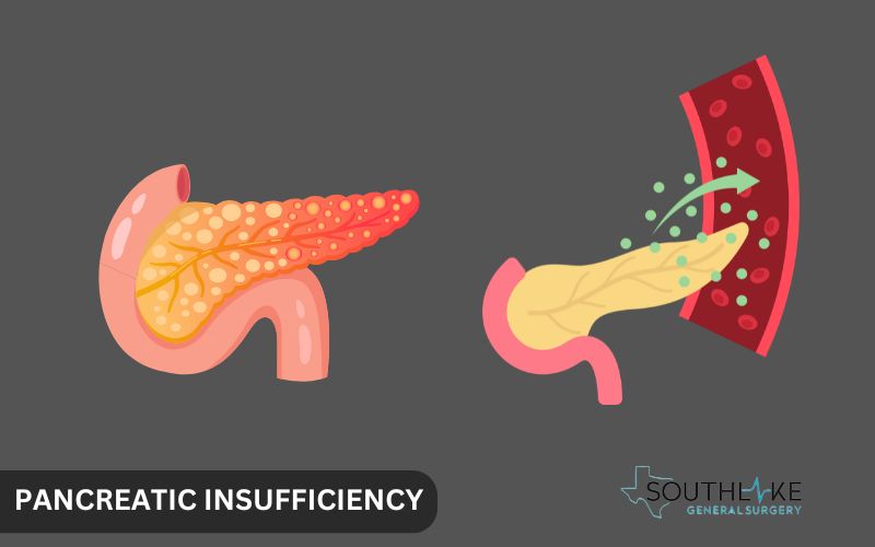 Illustration of the pancreas showing areas affected by chronic pancreatitis, highlighting enzyme production reduction."