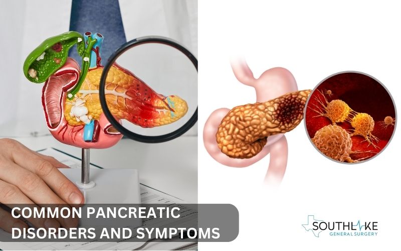 Symptoms and types of pancreatic disorders such as pancreatitis and pancreatic cancer.