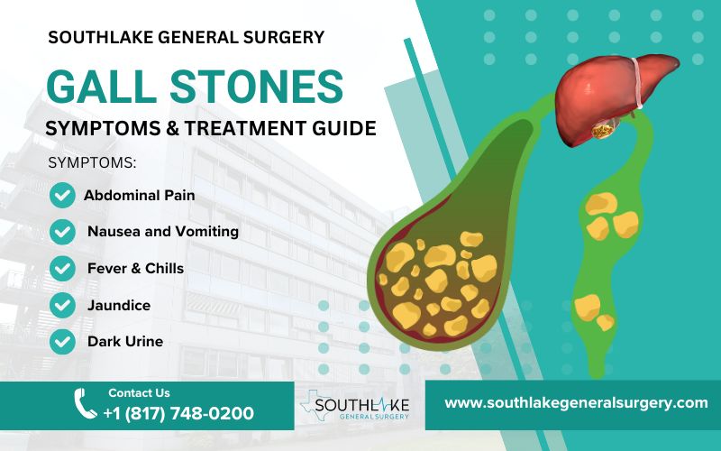 Cover image on gallstones treatment guide.