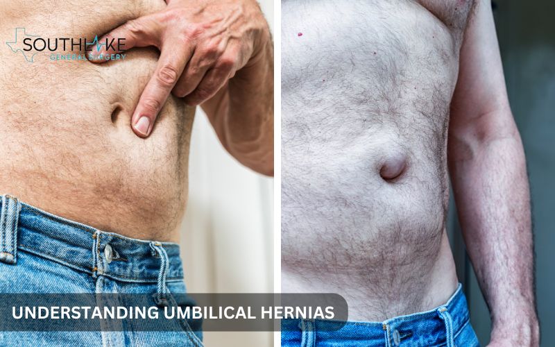 Image comparing a normal abdominal wall and one with an umbilical hernia near the navel.