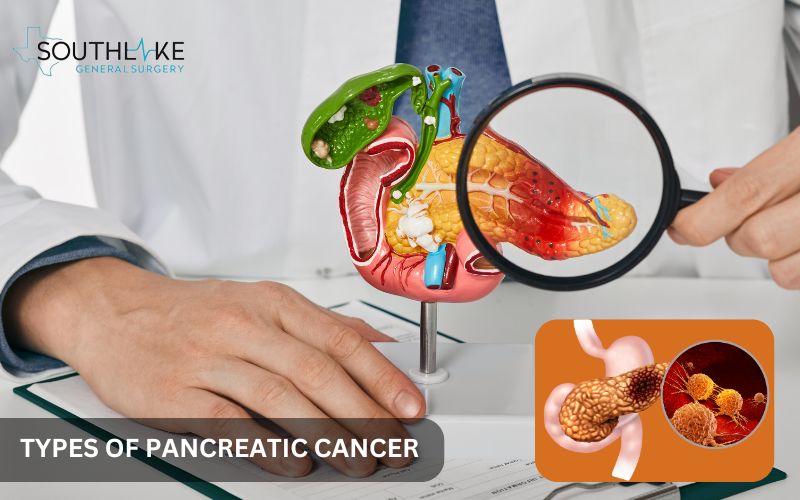 Illustration showing different types of pancreatic cancer and where they occur in the pancreas.