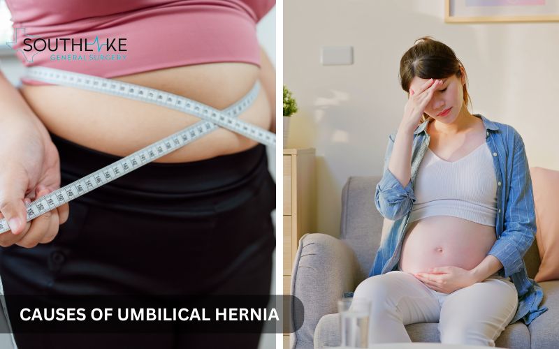 Images showing causes of umbilical hernias, including obesity and pregnancy-related strain.