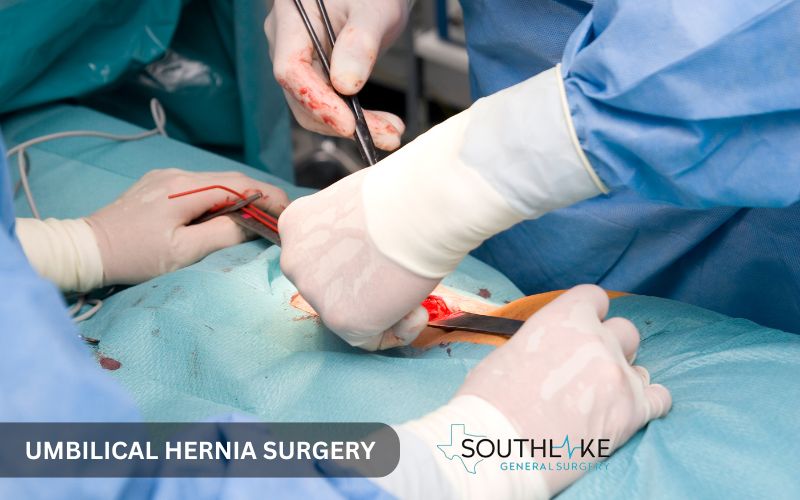 Illustration of umbilical hernia surgery with mesh placement for abdominal wall reinforcement.