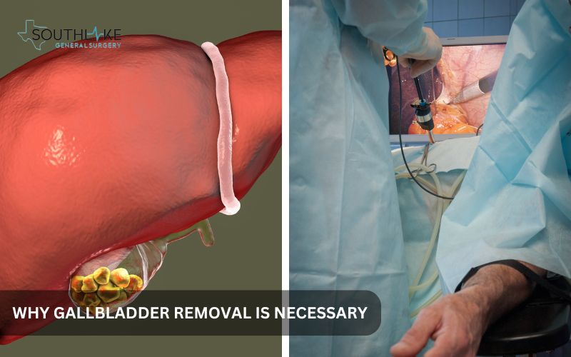 Illustration of the gallbladder showing gallstones and its removal process (Cholecystectomies).