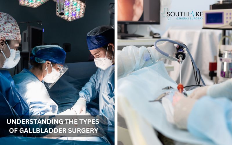 Comparison chart of laparoscopic vs. open cholecystectomy or Cholecystectomies procedures.