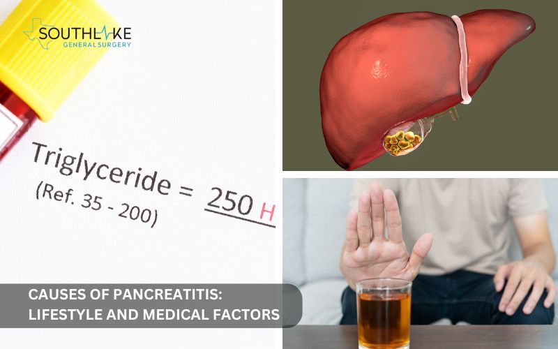 Graphic showing causes of pancreatitis, including gallstones, alcohol use, high triglycerides, and genetic predispositions.