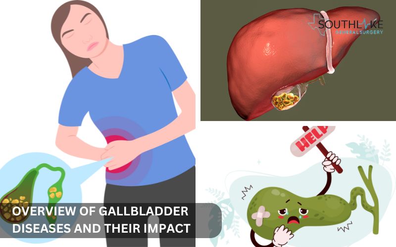 Illustration of gallbladder diseases including gallstones, cholecystitis, and bile duct blockage.