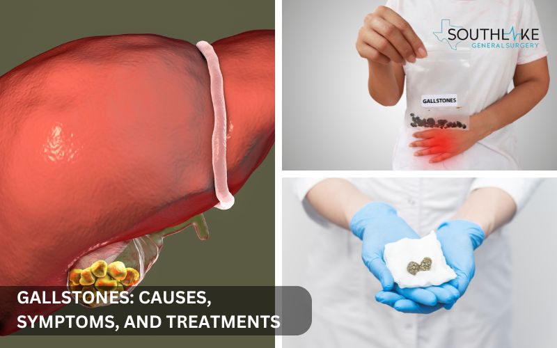 Image of gallstones in the gallbladder showing varying sizes and shapes. (Gallbladder Disease)