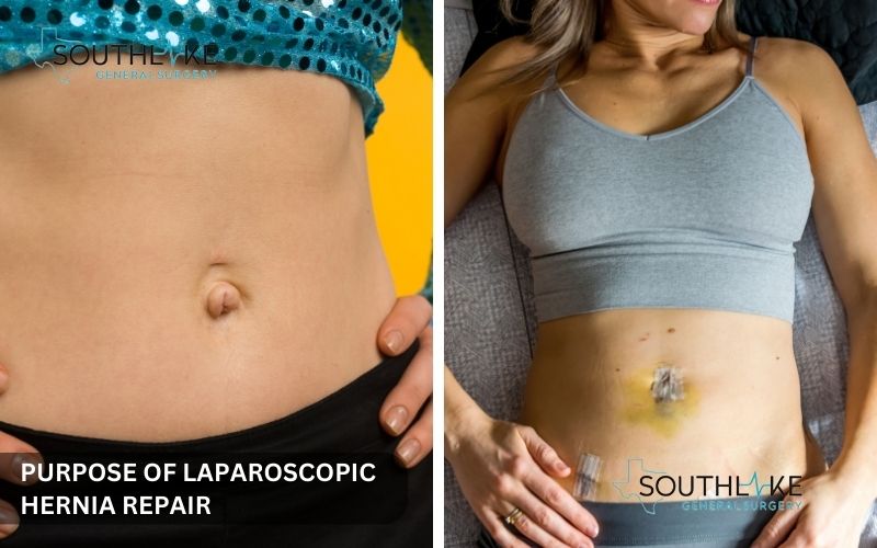 Before and after laparoscopic hernia repair: an untreated hernia versus a repaired hernia with minimal scarring.