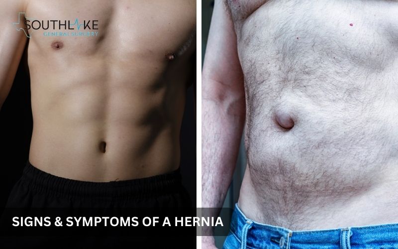 Comparison of a normal abdomen and an abdomen with a visible hernia bulge, showing signs and symptoms of a hernia.