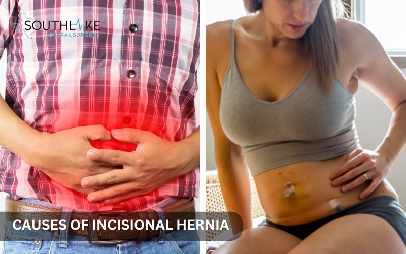 Factors leading to incisional hernia, including weak abdominal muscles and excessive strain on the surgical site.