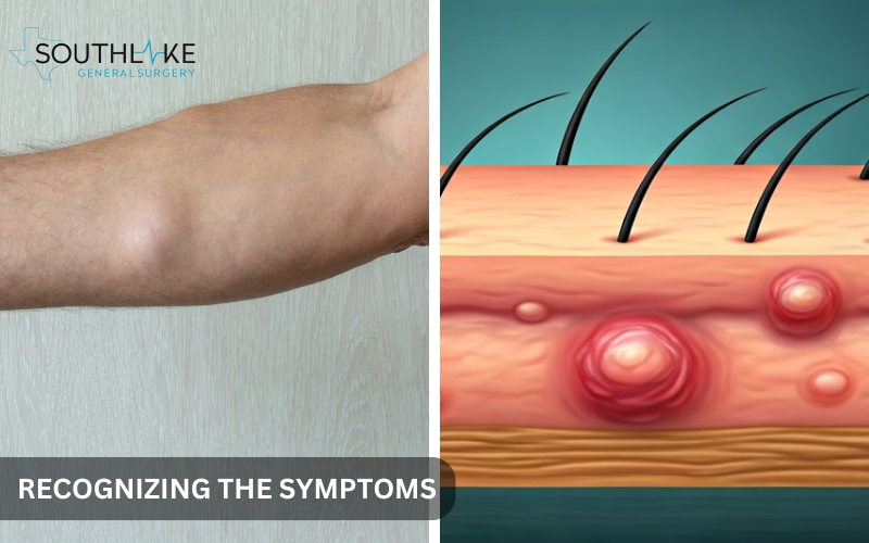 Close-up of a person's skin with a visible lipoma under the surface, illustrating common characteristics.