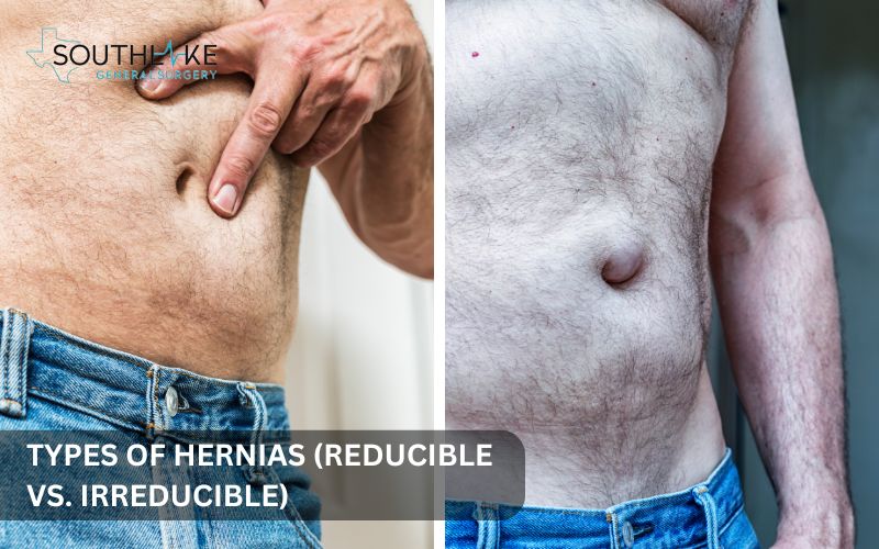 Comparison of reducible vs. irreducible hernia with medical illustrations showing their differences.