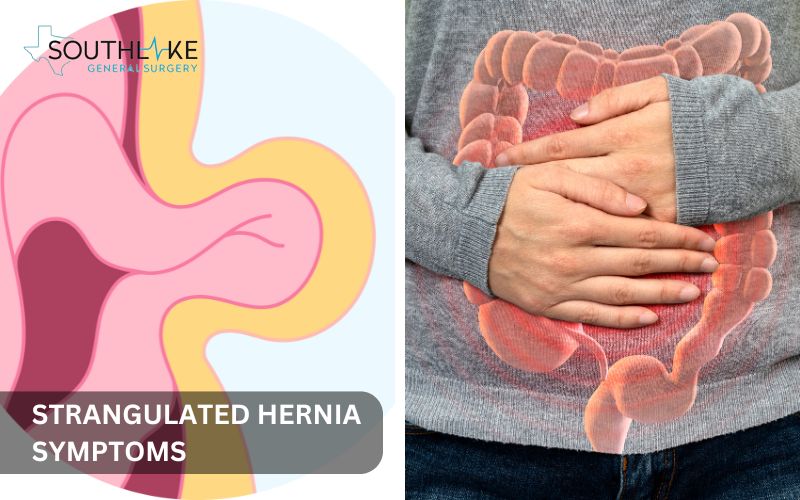 Medical illustration of a strangulated hernia with intestines trapped and blood flow restricted.