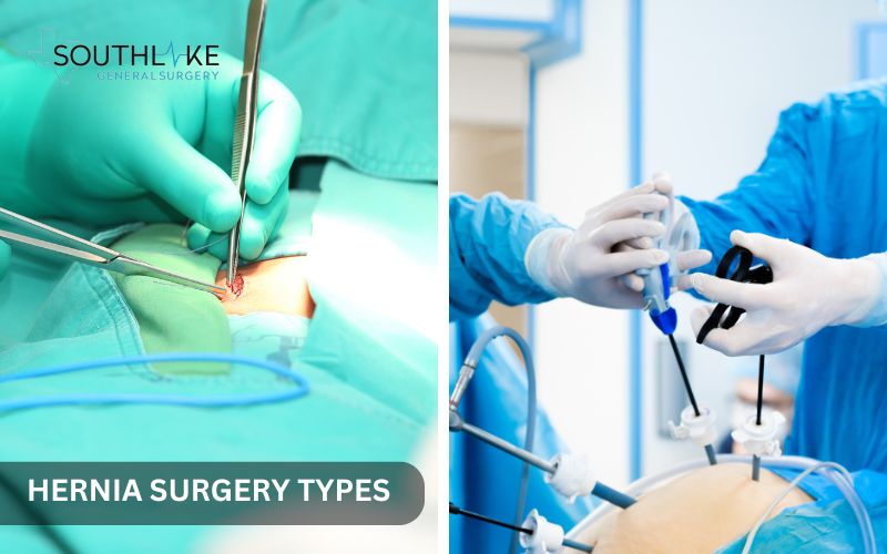 Comparison chart of open hernia surgery and laparoscopic repair hernia surgery.