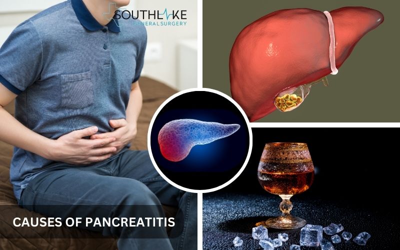 Illustration showing how gallstones and alcohol damage the pancreas, leading to inflammation.