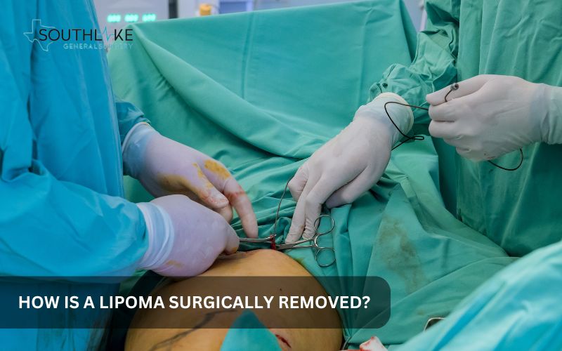 Illustration of lipoma removal surgery: a small incision and lipoma being extracted.