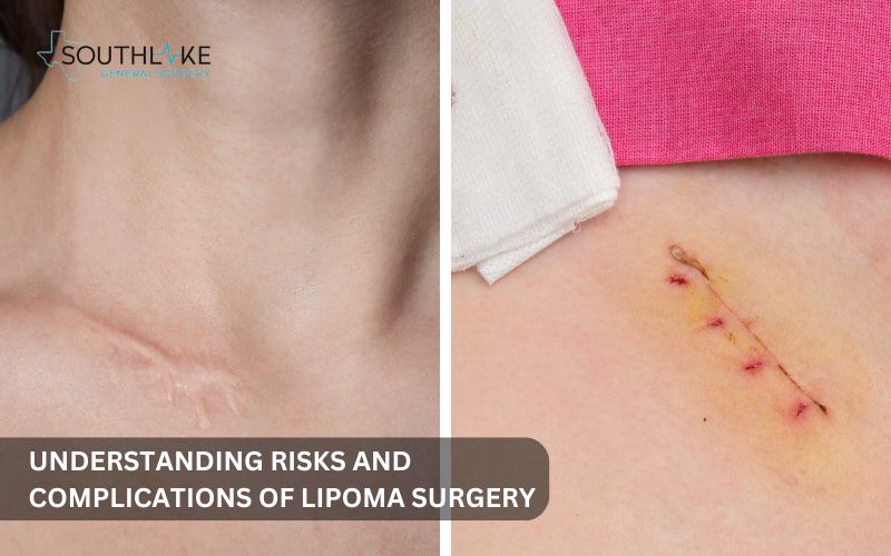 Infographic listing possible complications of lipoma surgery, such as infection, bleeding, and scarring.