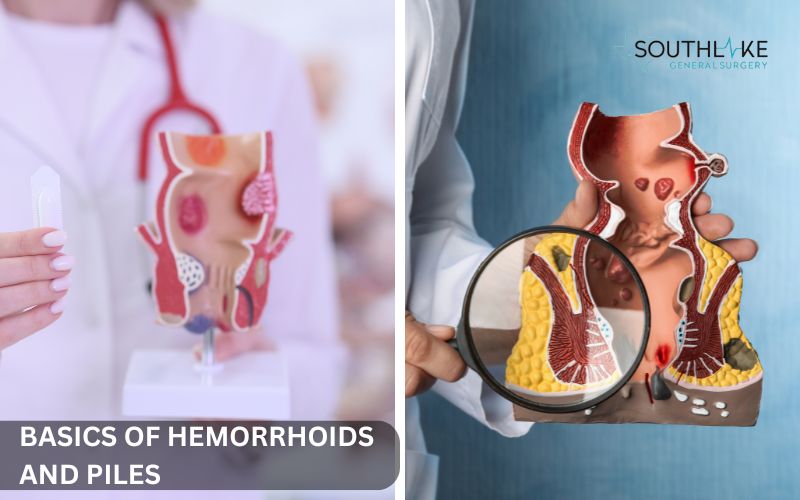 Comparison of internal and external hemorrhoids with labels indicating symptoms and affected areas.