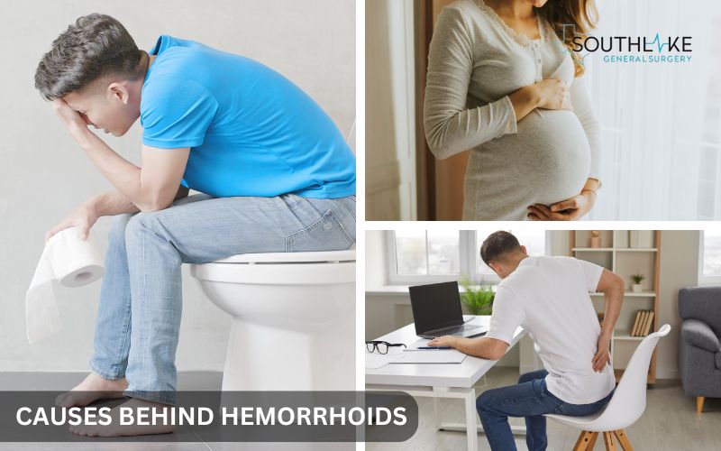 Illustration of common risk factors for hemorrhoids, including chronic constipation, pregnancy, obesity, and prolonged sitting.