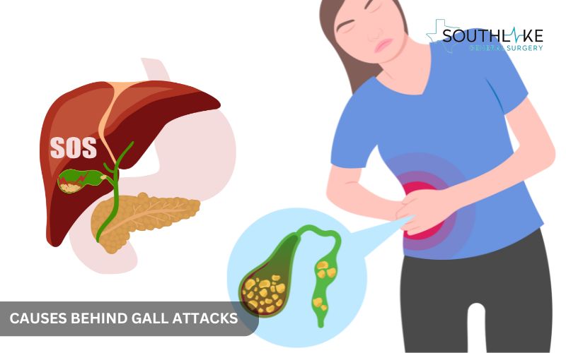 Illustration of gallstones blocking the bile duct, leading to gallbladder pain.